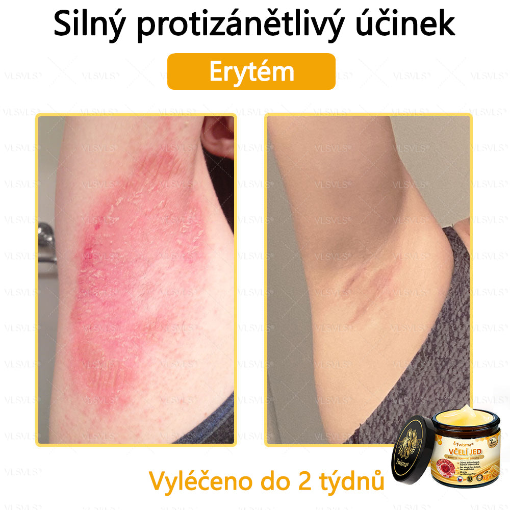 🐝Twisma® Krém s včelím jedem – doporučeno kožními lékaři 🧑‍⚕️ Na různé kožní problémy – fakt účinný a šetrný pomocník