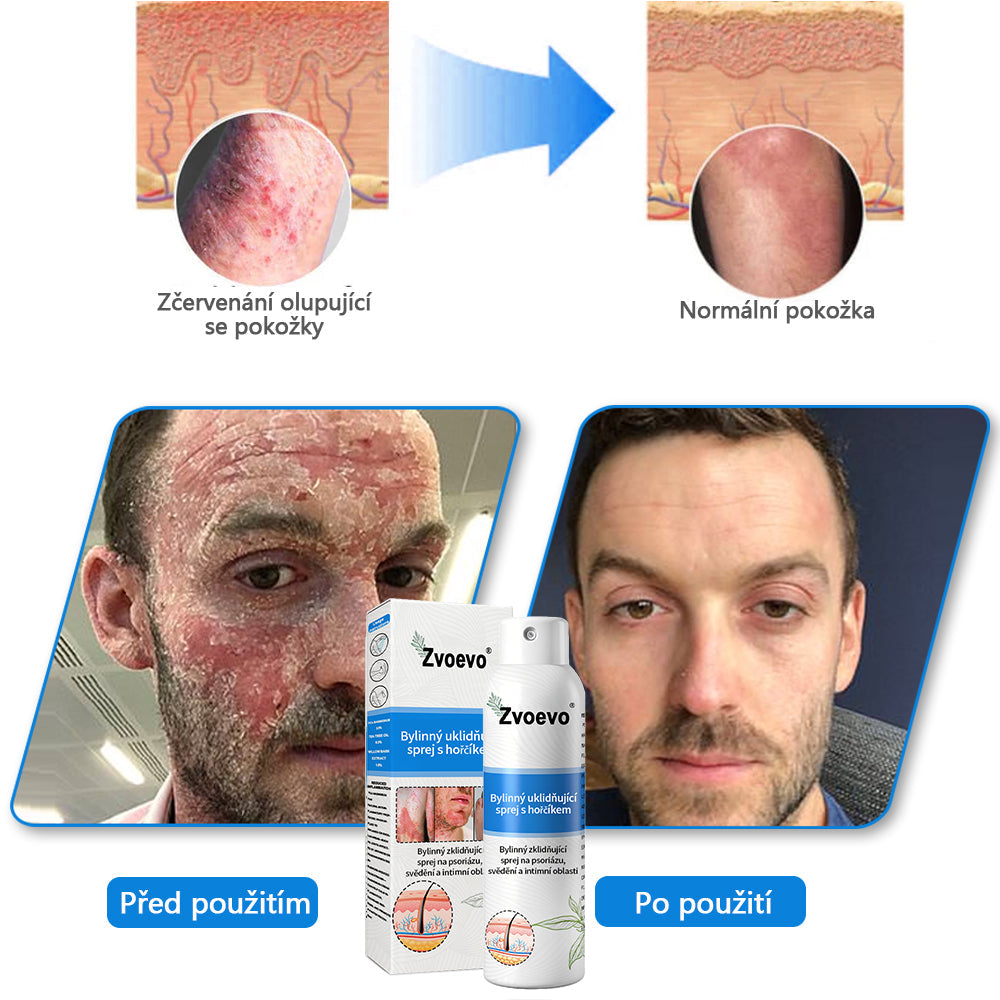 💪 Oficiální obchod: Twisma® Magnesium bylinný sprej na lupénku ✅ CE certifikace (zmírňuje lupénku a ekzém, léčí akné a bradavice, podporuje hojení bakteriálních infekcí, snižuje kloubní a neuropatickou bolest)