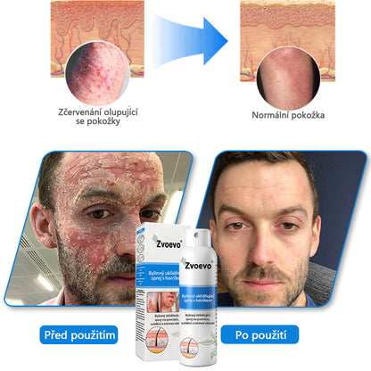 💪 Oficiální obchod: Twisma® Magnesium bylinný sprej na lupénku ✅ CE certifikace (zmírňuje lupénku a ekzém, léčí akné a bradavice, podporuje hojení bakteriálních infekcí, snižuje kloubní a neuropatickou bolest)